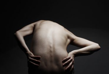 Woman with twisted back